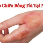 mẹo trị bỏng tỏi