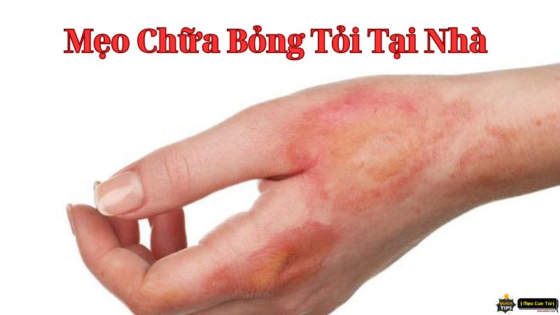 mẹo trị bỏng tỏi