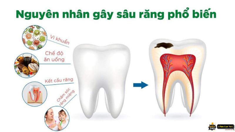 mẹo chữa sâu răng