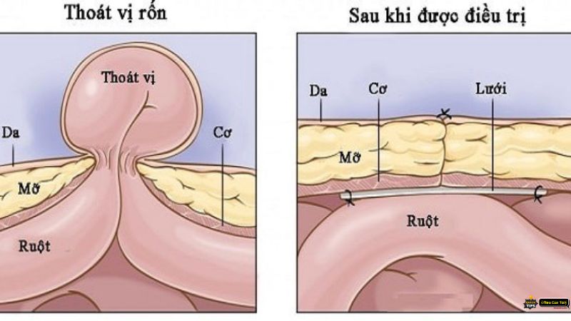 mẹo chữa rốn lồi ở người lớn